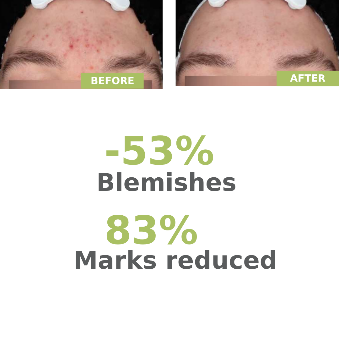 A-Derma Biology AC Night Peel Anti-Blemish Serum – product image 6