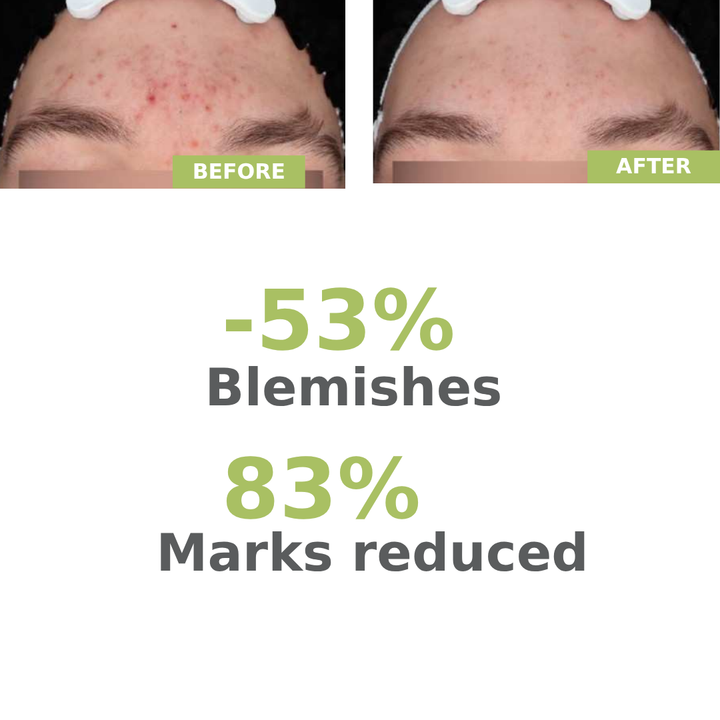 A-Derma Biology AC Night Peel Anti-Blemish Serum – product image 6