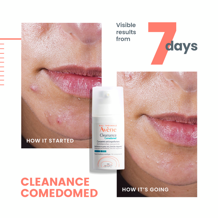 Avène Cleanance Comedomed Anti-Blemish Concentrate